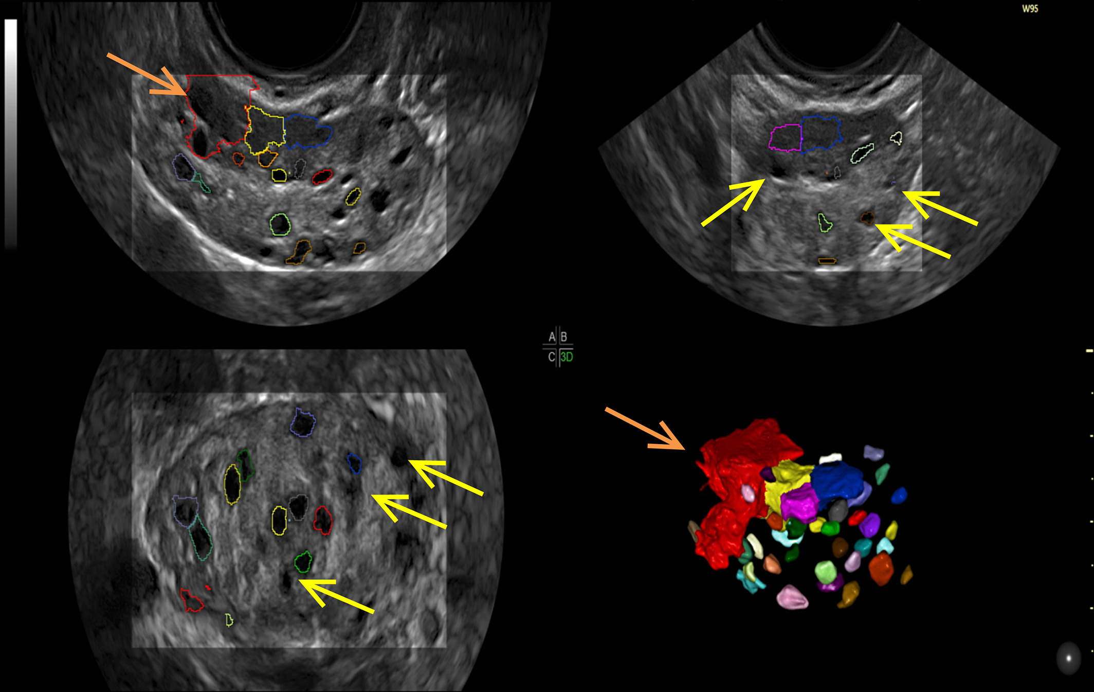 siêu âm nang trứng