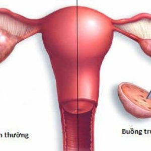 dấu hiệu cảnh báo suy buồng trứng sớm